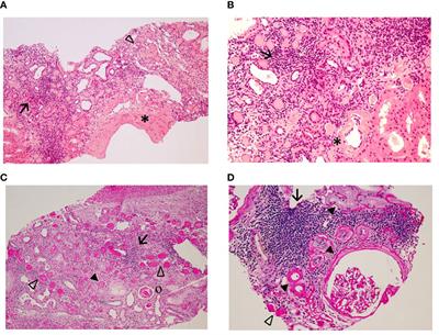 Canagliflozin on top of dual renin-angiotensin system blockade in a woman with partial acquired lipodystrophy, type 2 diabetes and severely proteinuric chronic kidney disease: a case report
